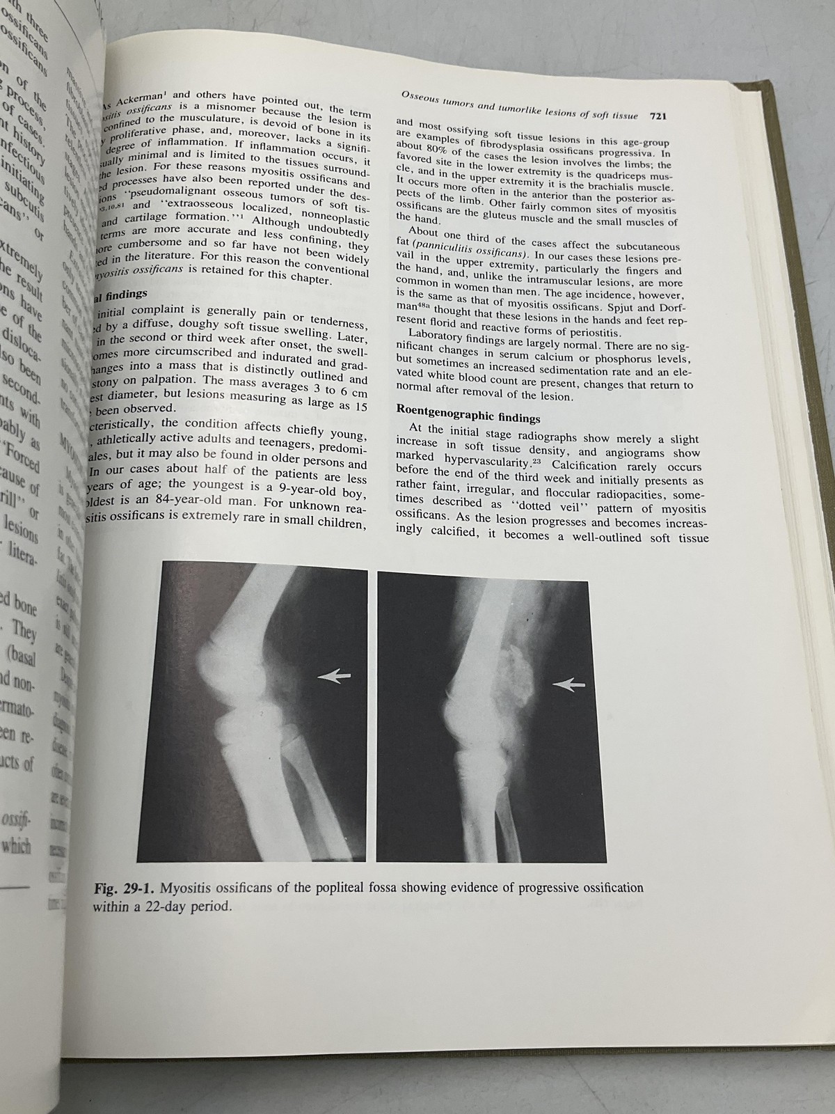 Soft Tissue Tumors Franz M. Enzinger Sharon W. Weiss Mosby Tan HC 1983