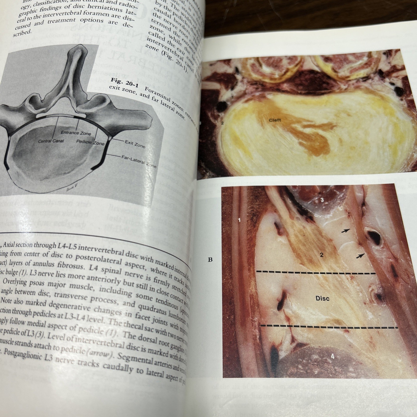 Lumbar Spine 2nd Edition Volumes 1 2 Medical Textbook Anatomy Orthopedic Surgery