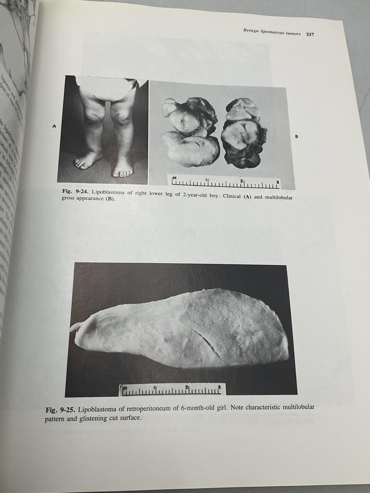 Soft Tissue Tumors Franz M. Enzinger Sharon W. Weiss Mosby Tan HC 1983